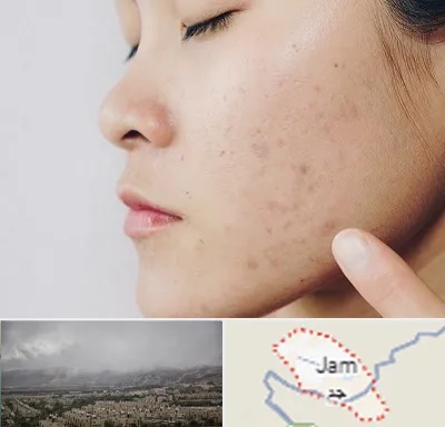 دکتر جوش صورت در جم