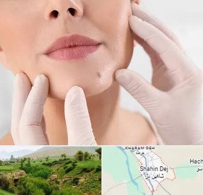 برداشتن خال در شاهین دژ