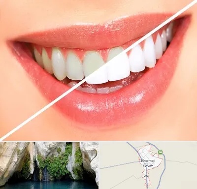بلیچینگ دندان در خورموج