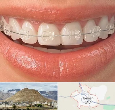 ارتودنسی اقساطی در گراش