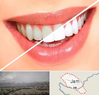 بلیچینگ دندان در جم