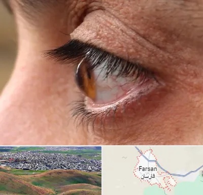 متخصص قوز قرنیه در فارسان