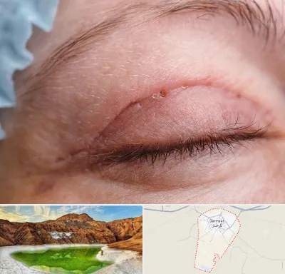 جراح پلک در گرمسار