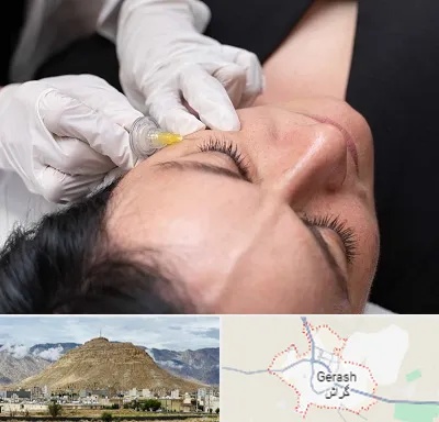 کربوکسی تراپی در گراش