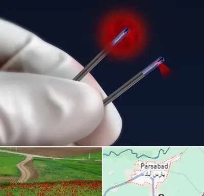 جراحی سینه با لیزر در پارس آباد