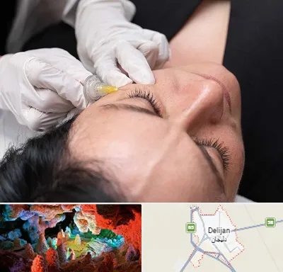 کربوکسی تراپی در دلیجان