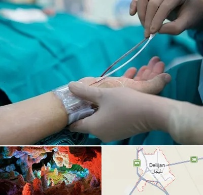 آنژیوگرافی در دلیجان