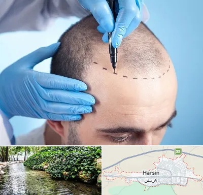 دکتر کاشت مو در هرسین
