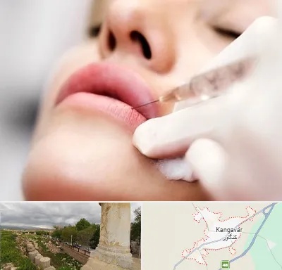 کلینیک تزریق ژل لب در کنگاور
