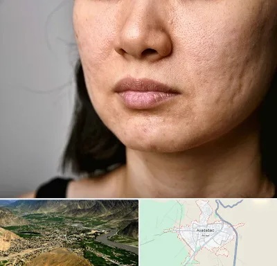 سابسیژن جای جوش در اسدآباد