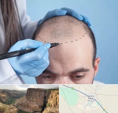 کاشت مو اقساطی در سرپل ذهاب