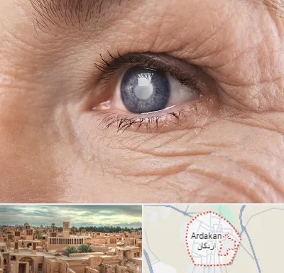متخصص آب مروارید در اردکان