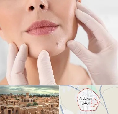 برداشتن خال در اردکان