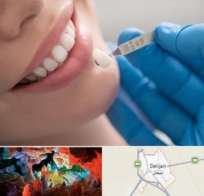 مرکز لمینت دندان در دلیجان