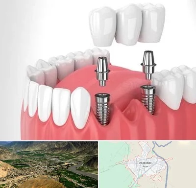 کاشت دندان در اسدآباد
