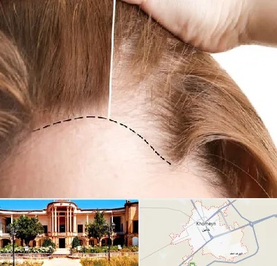 کاشت مو برای خانمها در خمین
