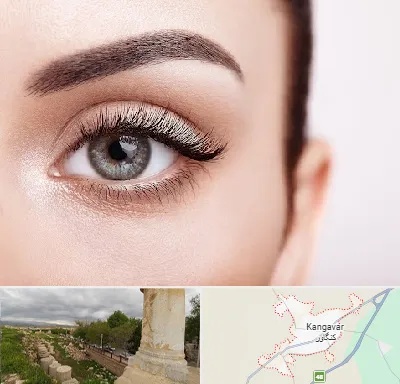 فوق تخصص عنبیه در کنگاور