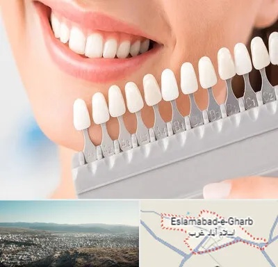 متخصص لمینت دندان در اسلام آباد غرب