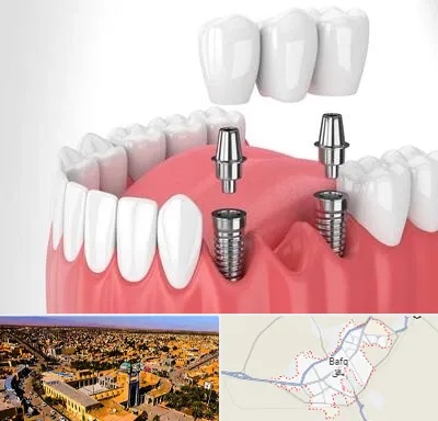 کاشت دندان در بافق