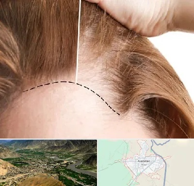 کاشت مو برای خانمها در اسدآباد