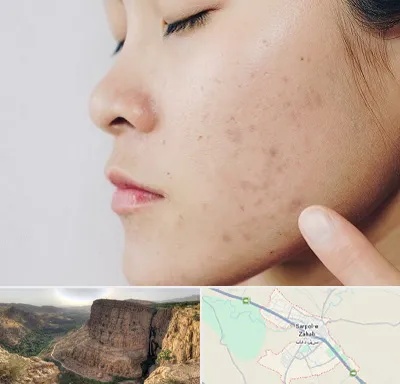 دکتر جوش صورت در سرپل ذهاب