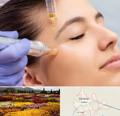 میکرونیدلینگ در محلات