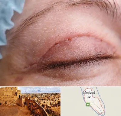 جراح پلک در میبد
