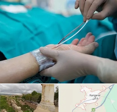 آنژیوگرافی در کنگاور
