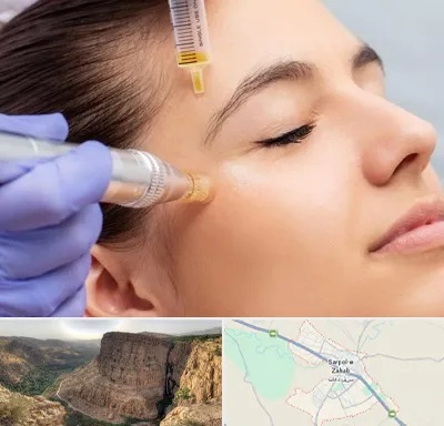 میکرونیدلینگ در سرپل ذهاب