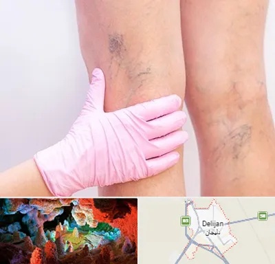 دکتر فوق تخصص واریس در دلیجان