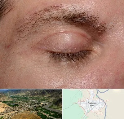 جراح بلفاروپلاستی در اسدآباد