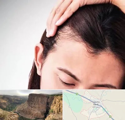 کاشت مو بانوان در سرپل ذهاب