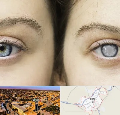 متخصص آب سیاه (گلوکوم) در بافق