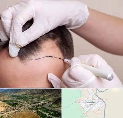 کاشت مو به روش SUT در اسدآباد