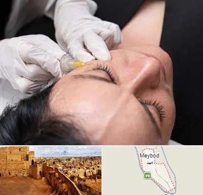 کربوکسی تراپی در میبد