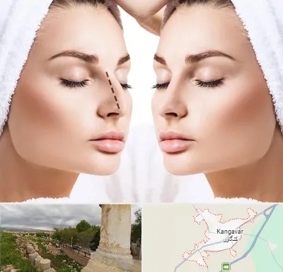 عمل بینی در کنگاور
