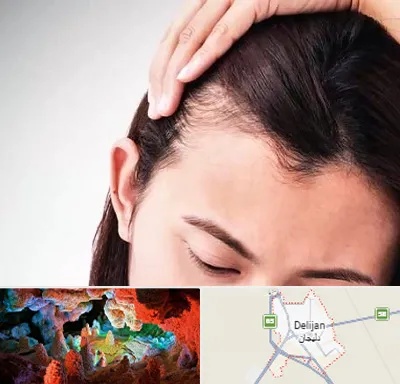 کاشت مو بانوان در دلیجان