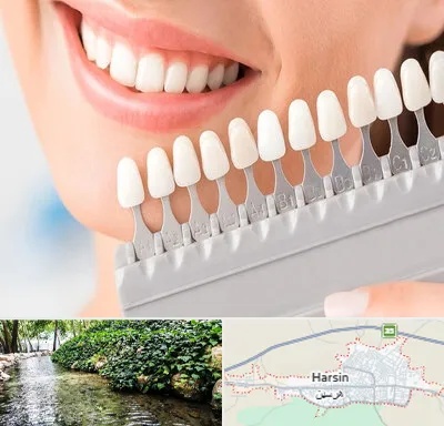 متخصص لمینت دندان در هرسین