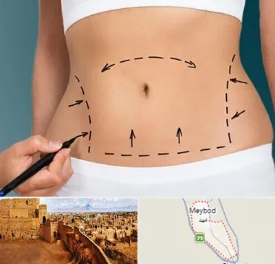 عمل ابدومینوپلاستی در میبد