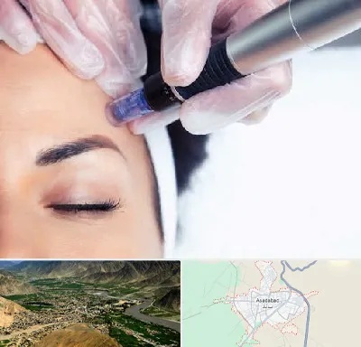 کلینیک مزوتراپی صورت در اسدآباد