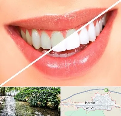 بلیچینگ دندان در هرسین