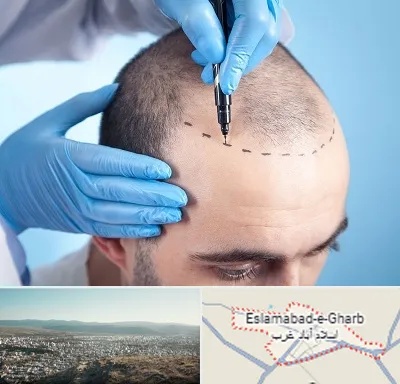 دکتر کاشت مو در اسلام آباد غرب