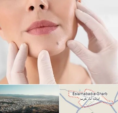 برداشتن خال در اسلام آباد غرب