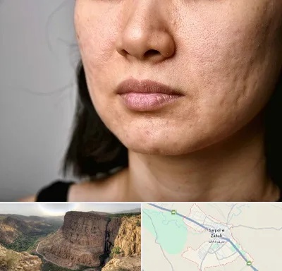 سابسیژن جای جوش در سرپل ذهاب