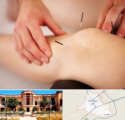 دکتر طب سوزنی برای لاغری در خمین