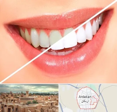 بلیچینگ دندان در اردکان