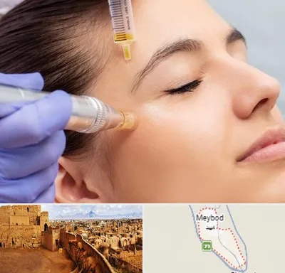 میکرونیدلینگ در میبد