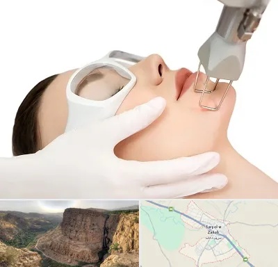 لیزر فرکشنال در سرپل ذهاب