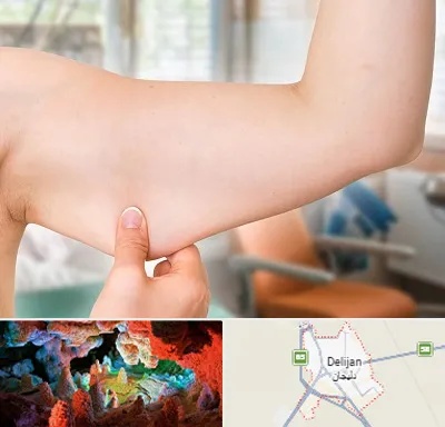 براکیوپلاستی در دلیجان