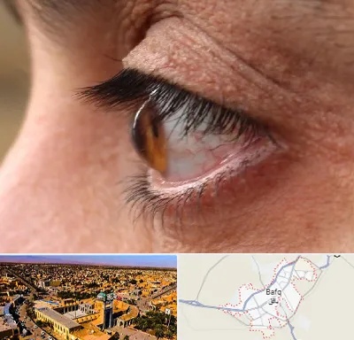 متخصص قوز قرنیه در بافق